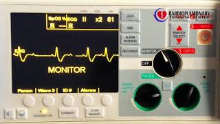 Second degree type II AV block with PVCs [upl. by Tiphane541]