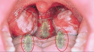 Home Remedies to Treat Mononucleosis  How to back Normal Throat [upl. by Jade]