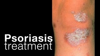 Psoriasis treatment options  related issues [upl. by Polard]