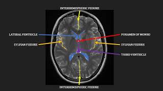 Introduction to MRI of the brain [upl. by Sterner897]