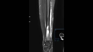 Osteomyelitis of tibia with follow up [upl. by Ahsiyn]