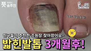 밟힌 피멍발톱 3개월후 문제성 발톱으로 변해가는 모습보고 친구분들이 추천한 조원장네 찾아왔어요 조원장의풋솔루션 레푸스상도점 문제성발관리 refuss 서울레푸스 [upl. by Einyaj165]