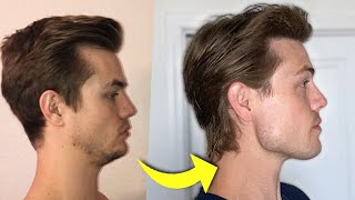 How I Fixed My Receding Chin [upl. by Aihsoj50]