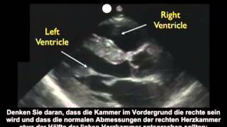 Anleitung Kardiologische Ultraschalluntersuchung – parasternal lange Achse – Teil 1 [upl. by Anirad]