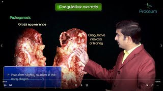 Necrosis and types of Necrosis  General pathology  Animated usmle videos [upl. by Ruhl10]