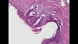 Histopathology CervixSquamous metaplasia amp carcinomainsi [upl. by Hugh]