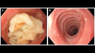 Eosinophile Ösophagitis [upl. by Malas670]