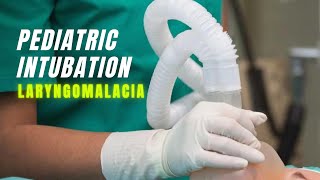 Pediatric Intubation  With Laryngomalacia [upl. by Aniaj]