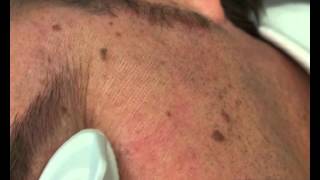 Doctor Beauty  Laser Erbium YAG skin resurfacing with Pluser Fraxtion [upl. by Barthelemy130]