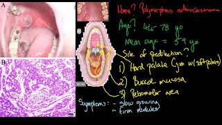 polymorphous adenocarcinoma [upl. by Adnole809]