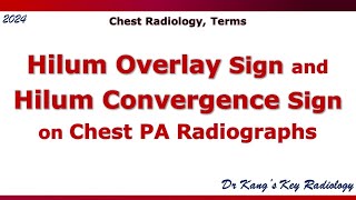 Hilum overlay sign and Hilum convergence sign [upl. by Auqcinahs]