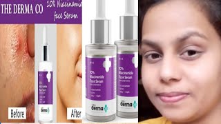 the derma co 10 niacinamide face serum for acne marks review  10 niacinamide serum [upl. by Clynes]