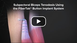 Subpectoral Biceps Tenodesis Using the FiberTak® Button Implant System [upl. by Blank294]