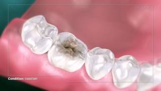 Tooth Anatomy  3D Medical Animation [upl. by Hanshaw]