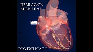 Fibrilación Auricular ECG Patogenia y tratamiento [upl. by Amatruda]