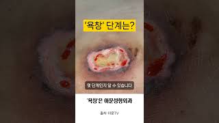 욕창 단계는 깊은 욕창 죽은 조직 제거술 수술 병원 pressure sore bedsore surgery hospital seoul korea아문TV [upl. by Nerhtak]