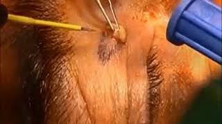 Xanthelasma Skin Tag and Mole removal [upl. by Khai]