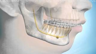 Chirurgie orthognatique ostéotomie mandibulaire [upl. by Jacob]