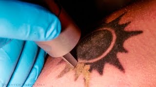 How Laser Tattoo Removal Works  Smarter Every Day 123 [upl. by Ahsatal623]