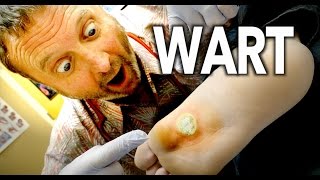 WORLDS LARGEST WART Frozen With Liquid Nitrogen  Dr Paul [upl. by Strickler]