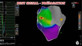 WPW ABLATION DELTA WAVE AUTOMATIC MAPPING quotTHE WORKFLOWquot [upl. by Malcah]