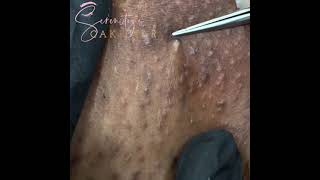 Blackheads Ingrown hair  and Cop Stories [upl. by Schaffer]