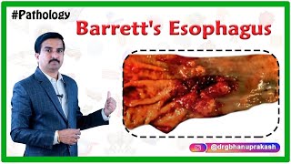 Barretts esophagus Pathology Lecture  Usmle Quick review  Dr Bhanu prakash [upl. by Acinnod]