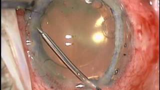 Baseer U Khan MD Dislocated Cataract Extraction CTS Iridodialysis Repair and Pupil Cerclage [upl. by Harod]