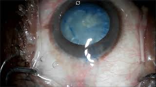 Rhexis in intumescent mature cataract [upl. by Bertle]