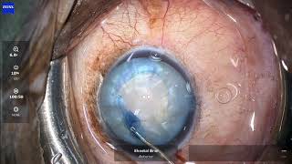 Spiral Rhexis For Intumescent Cataracts [upl. by Traci]