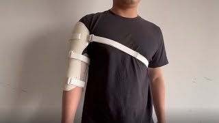 Humeral Fracture Splint for Broken Humerus [upl. by Cirted191]