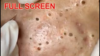 LARGE Blackheads Removal  Best Pimple Popping Videos [upl. by Hnid]