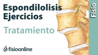 Espondilolisis y espondilolistesis  Tratamiento con ejercicios automasajes y estiramientos [upl. by Litt]