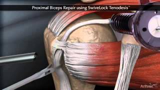 Тенодез сухожилия длинной головки бицепса Proximal Biceps Repair using SwiveLock Tenodesis [upl. by Buford]