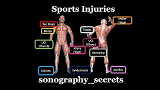 Ultrasound of Sports injuries by sonographysecrets [upl. by Elbam]