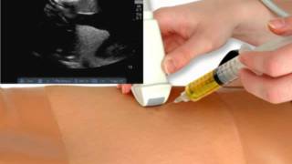 Thoracostomy amp Ultrasound Thoracentesis Model [upl. by Clayton52]