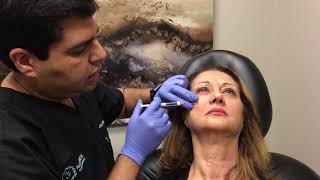 MMLift  Restylane Lyft  Nasolabial folds [upl. by Embry]