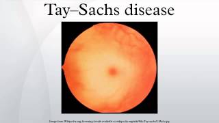 Tay–Sachs disease [upl. by Oaks]