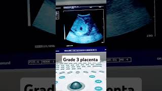 Grade 3 placenta localization at Anterior side ultrasound fetalheartshortvideo foryou [upl. by Chaim271]