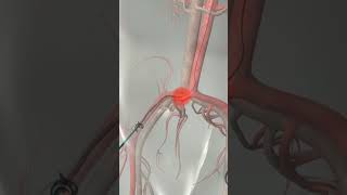 Learn How Cardiac Catheterization Works [upl. by Banks]