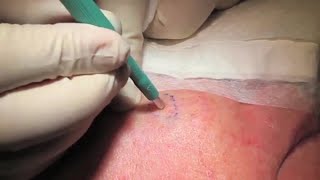 Punch Biopsy  Professor David Wilkinson  Professional Certificate of Skin Cancer Medicine [upl. by Izy]