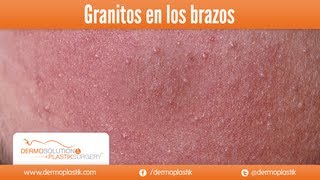 Dermoplastik  Granitos en los brazos [upl. by Mable]