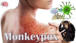 Monkeypox The Latest Outbreak  Everything You Need To Know  History Prognosis Treatment [upl. by Eilasor235]