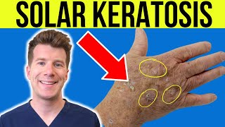 Doctor explains Actinic Solar Keratosis  Sun damaged skin  causes symptoms and treatment [upl. by Nnylcaj]