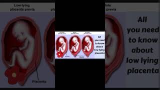 Low Laying Placenta In pregnancy Normal Delivery With Anwal ka Niche Hona Nuksan Ya Faid ytshorts [upl. by Therron]