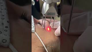 CO2 Laser for Upper Blepharoplasty Scars  with Dr Kami Parsa MD [upl. by Idzik296]