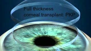 Full Thickness Corneal Transplantation Penetrating Keratoplasty PKP [upl. by Shanney]