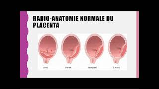 Anomalies dinsertion placentaire [upl. by Melessa]