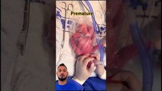 premature baby  🤲 shorts baby prematurebaby viral shortsfeed [upl. by Notirb410]