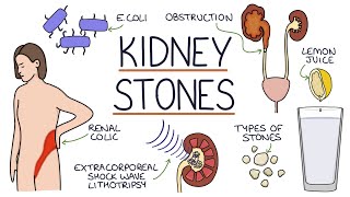 Understanding Kidney Stones [upl. by Amadis]